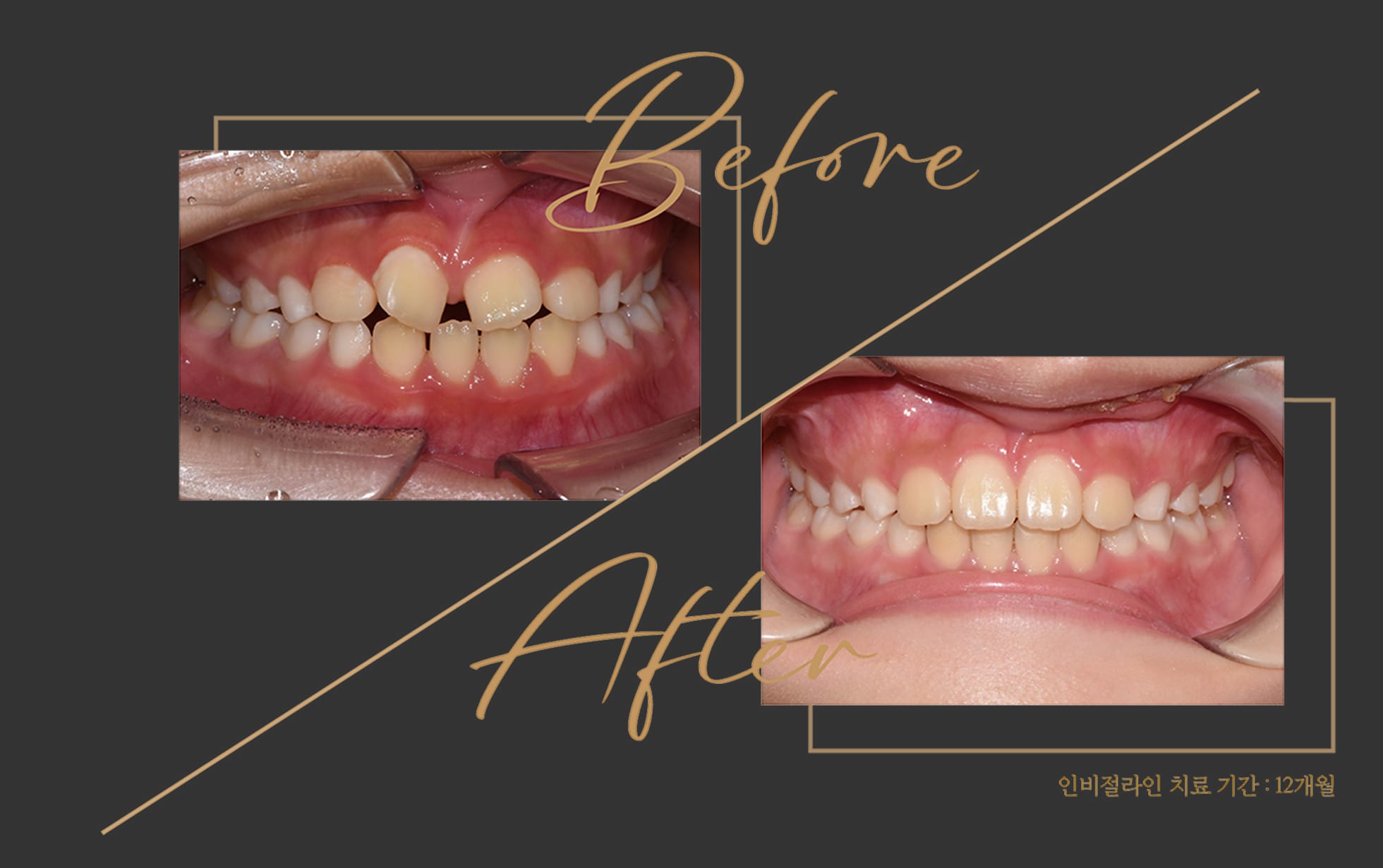 인비절라인 치료 비포 애프터 이미지