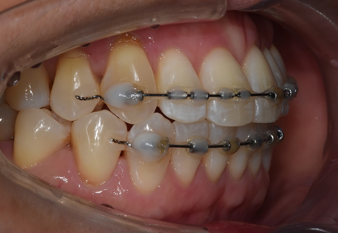 부분교정 시술 치아 이미지