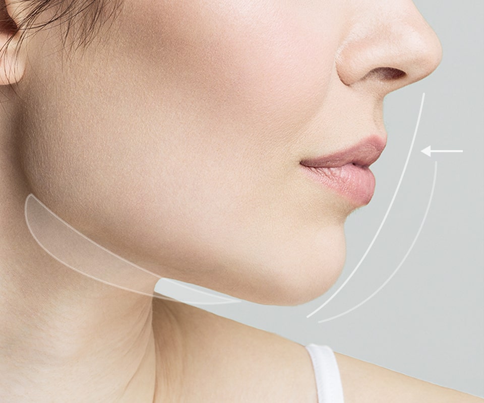 치아 교정 이미지