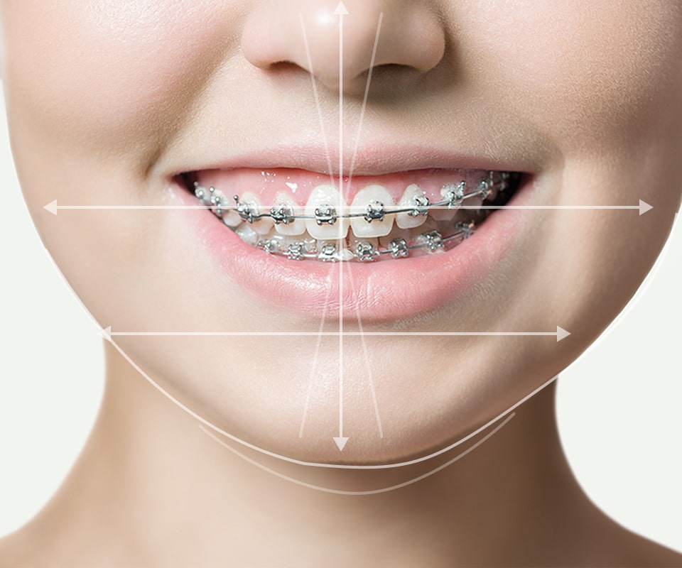 치아 교정 이미지