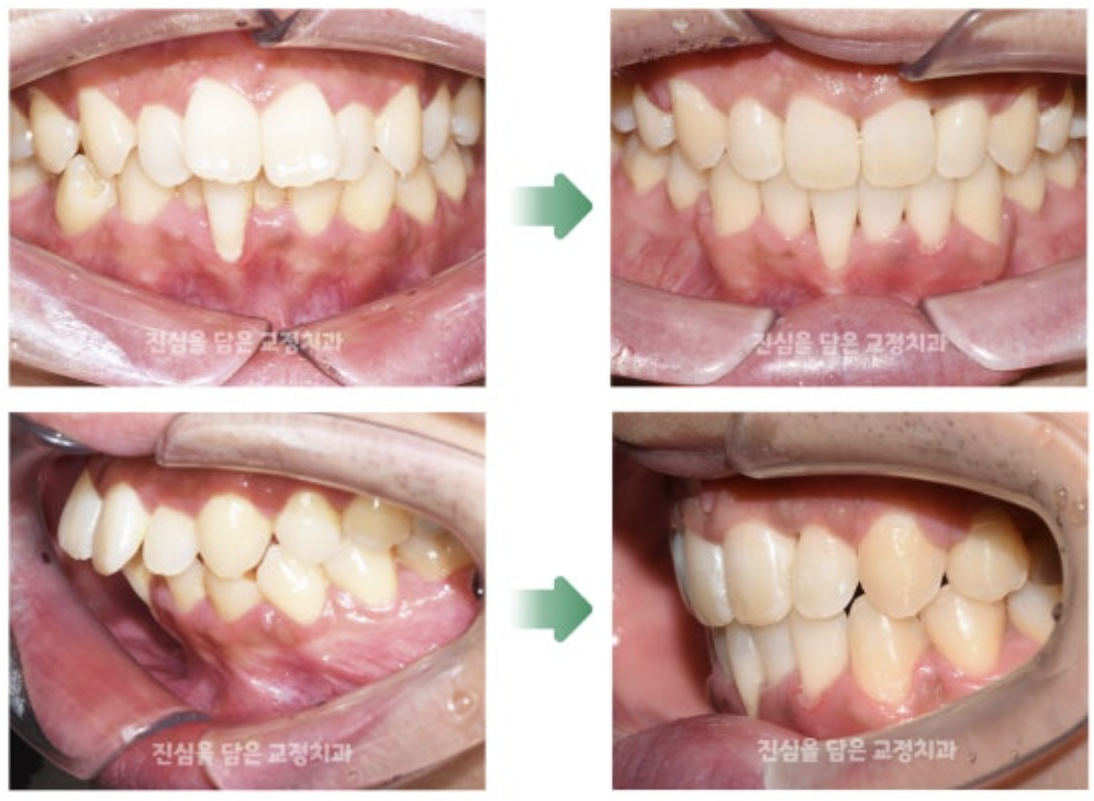 돌출입을 가진 30대 환자분의 교정 치료 사례