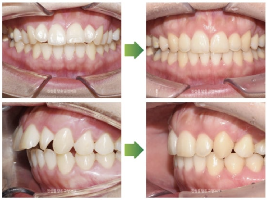 돌출입을 인비절라인을 통해 개선한 30대 여성분의 사례