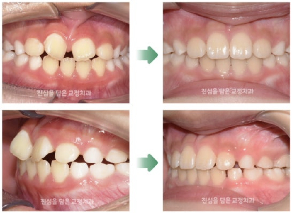 앞니가 벌어져 인비절라인 퍼스트 치료를 받은 10대 환자의 사례
