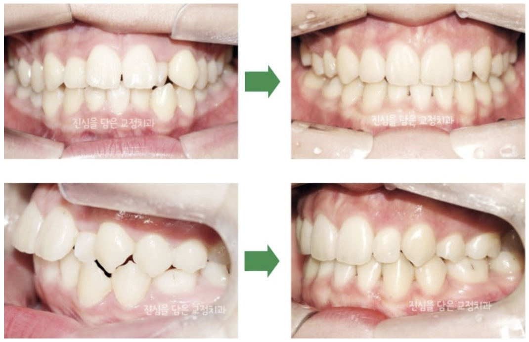 아래 앞니 1개 결손, 왜소치 및 돌출입을 개선한 사례