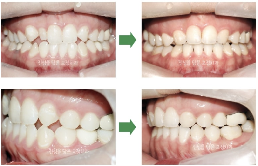 결손치와 왜소치가 있는 20대 환자분의 사례