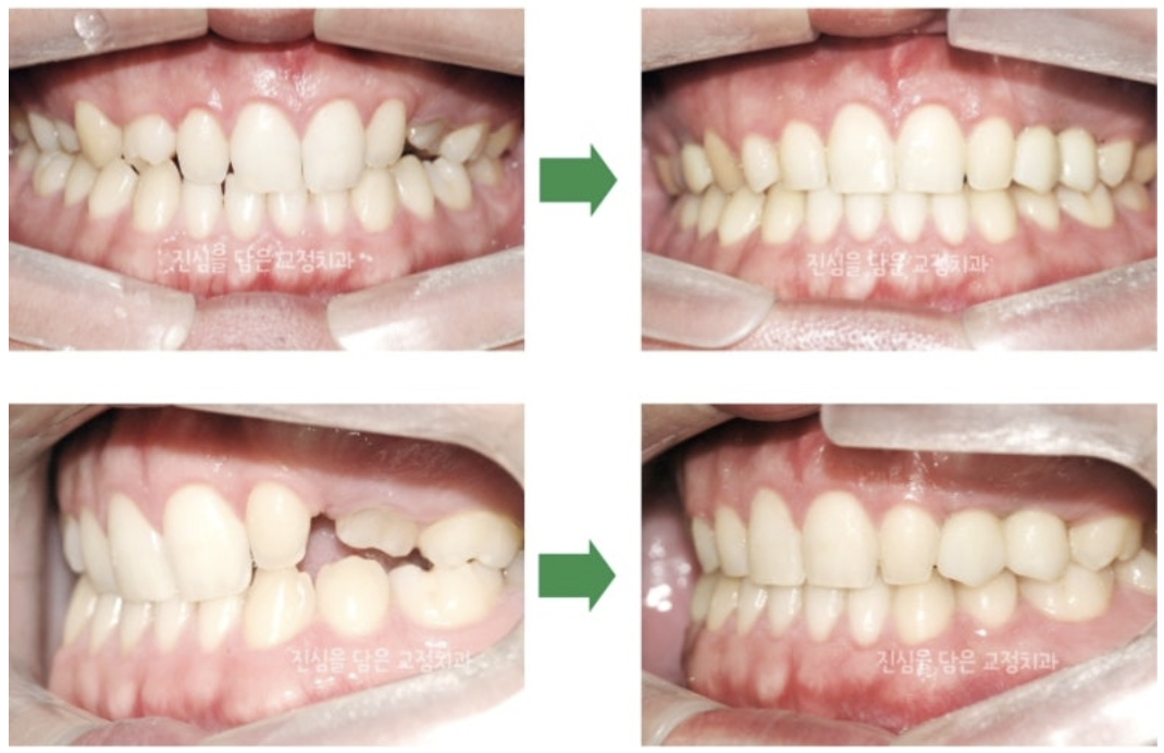 결손치를 교정과 임플란트를 통해 개선한 사례