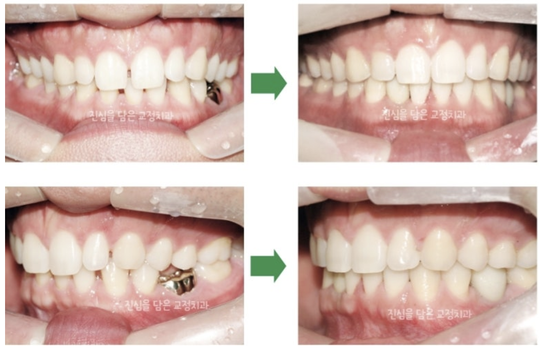 결손치로 벌어진 치열을 임플란트와 교정으로 개선한 사례