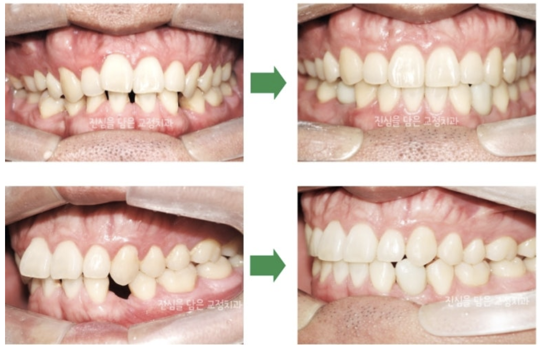 결손치와 벌어진 치열을 임플란트, 교정을 통해 개선한 사례