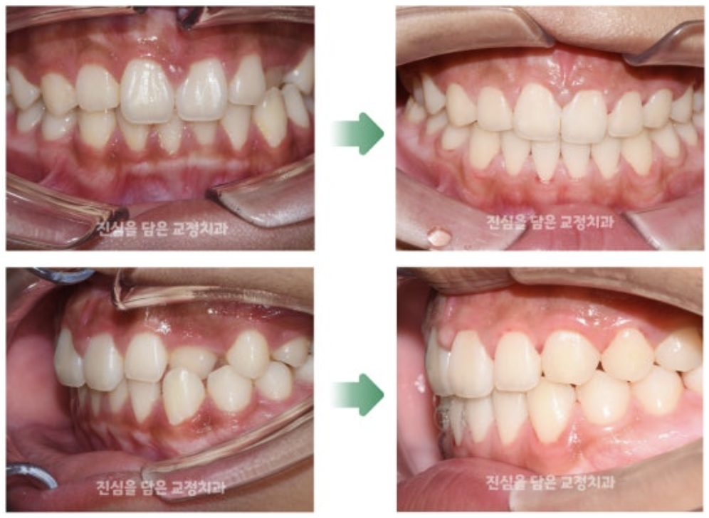 비발치 교정을 통해 비대칭을 개선한 사례
