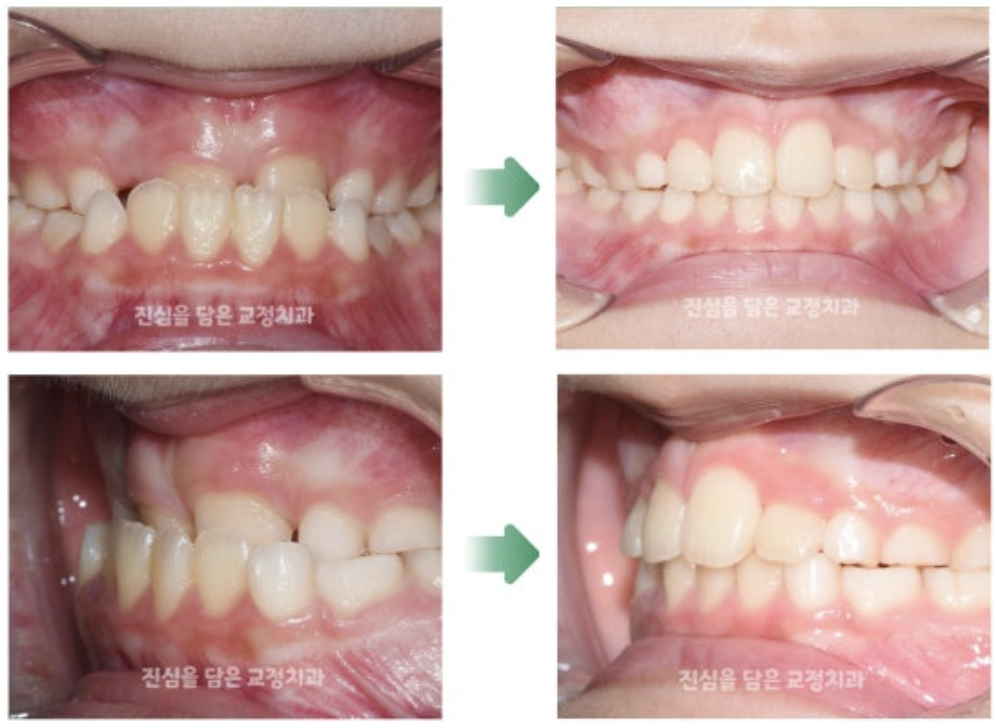 앵글씨 3급 부정교합을 구외장치를 이용한 개선 사례