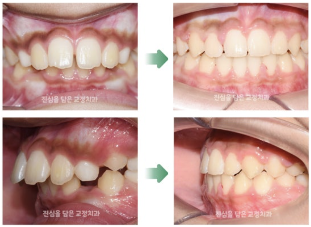 트윈블럭으로 무턱, 돌출입을 개선한 사례