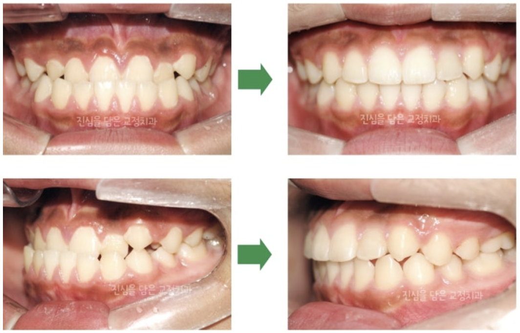 교정용 스크류를 활용해 청소년 반대교합을 개선한 사례