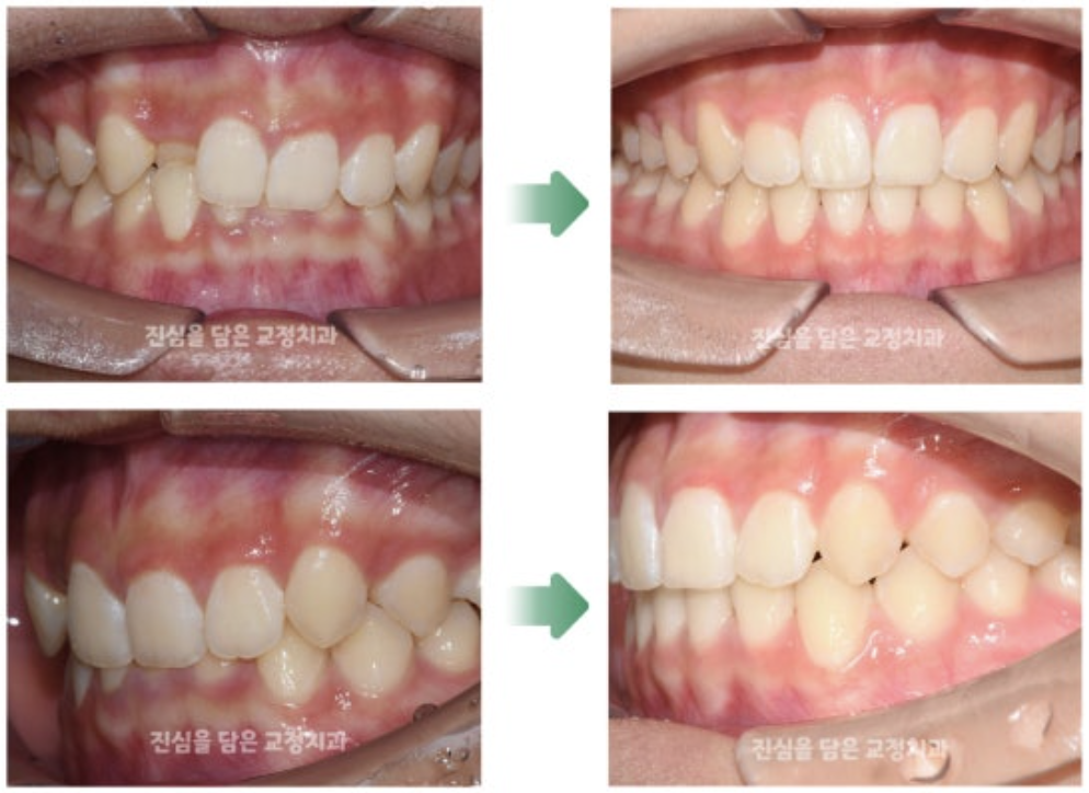비발치 교정을 통해 덧니와 과개교합을 교정한 10대 환자분의 사례