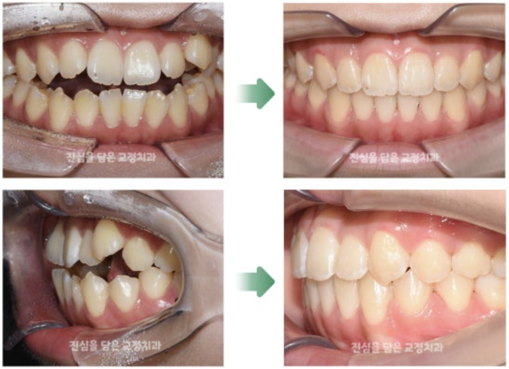 비발치로 개방교합 교정을 진행한 20대 환자분의 사례