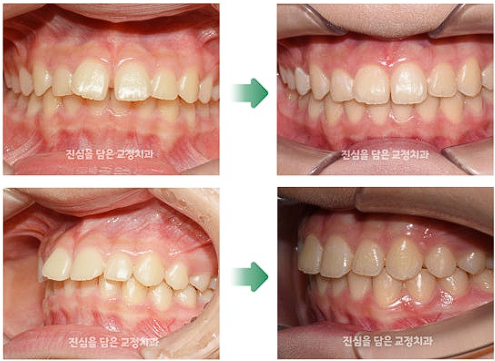 인비절라인 라이트를 통해 벌어진 치열을 개선한 사례