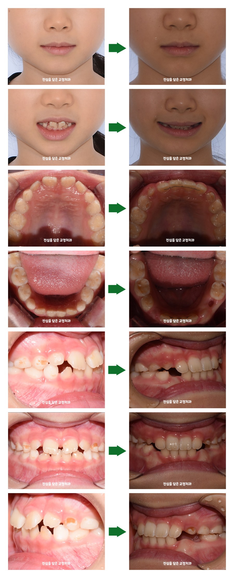 (4)김다인퍼스트_최종 결과 비교.jpg